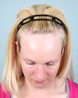 Before Hair Transplant&nbsp;Hairline